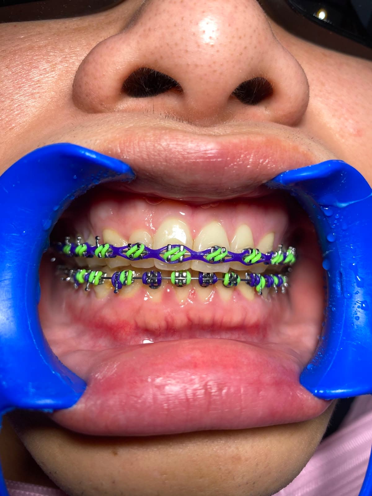 Tooth Separation — 1
