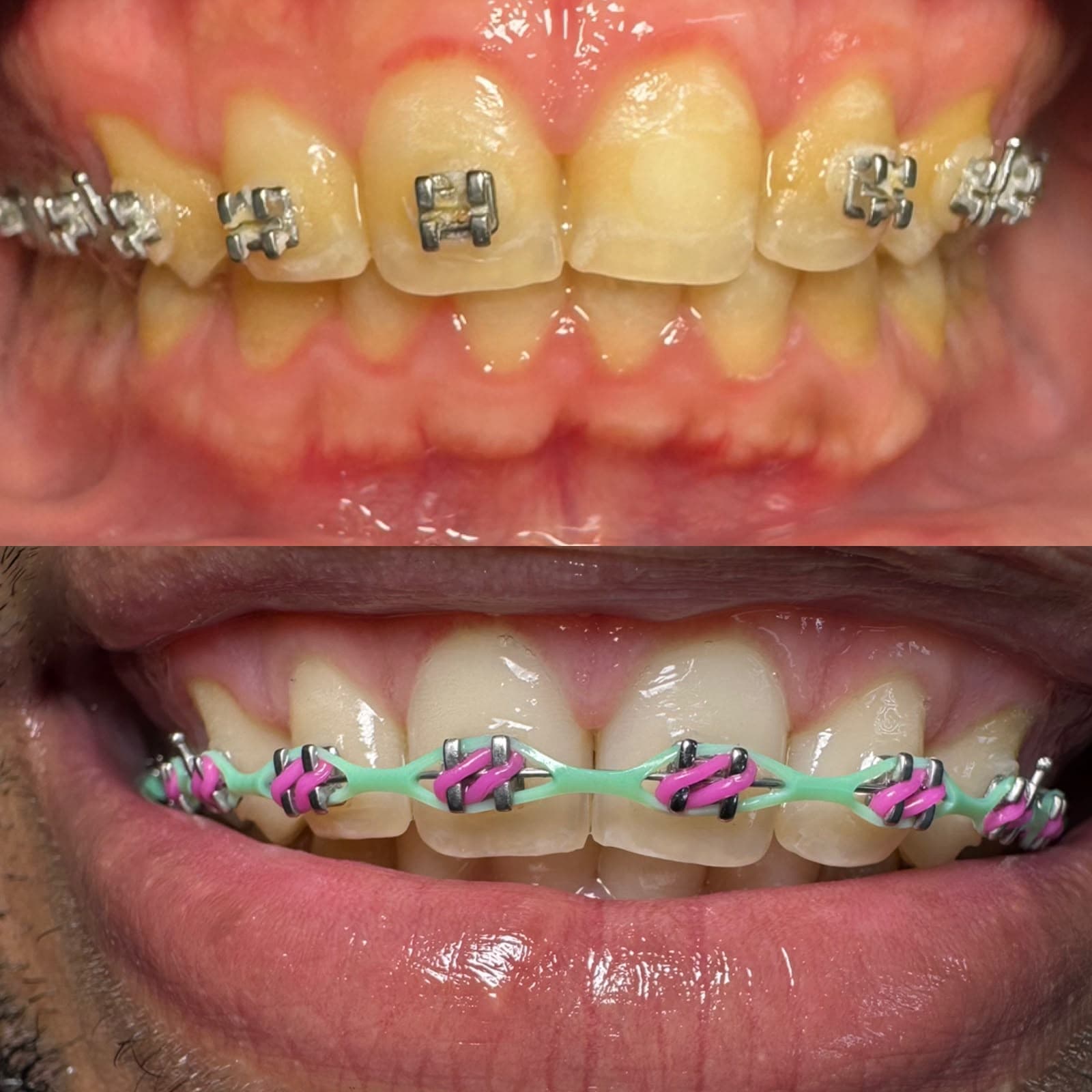 Gold Braces — 5