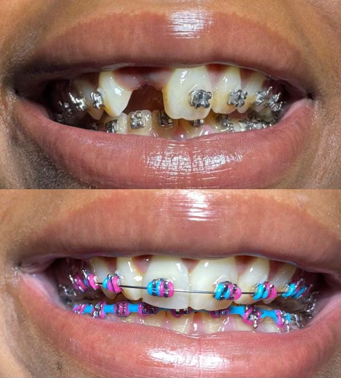 Fillings & Restorations — 4