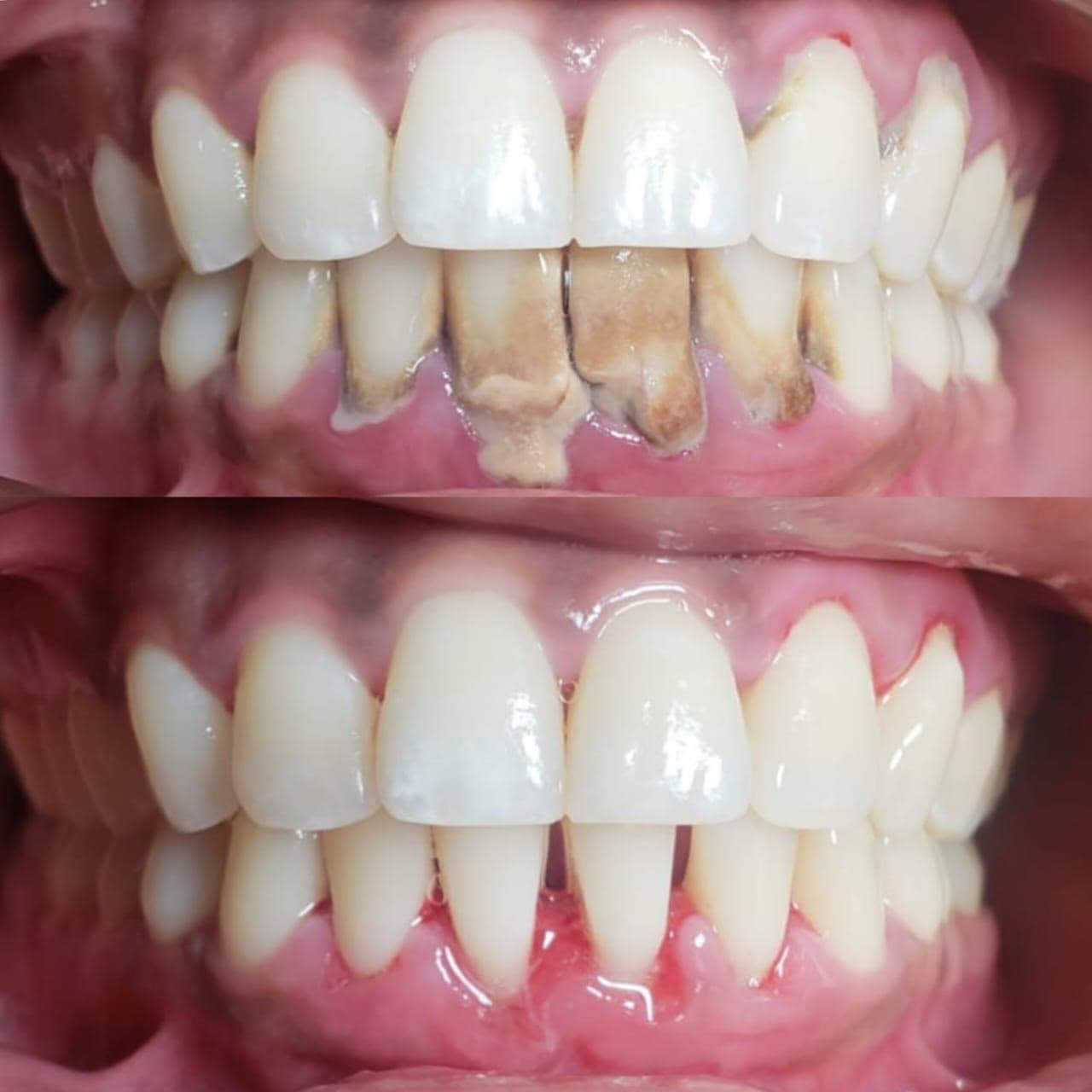 Fillings & Restorations — 2