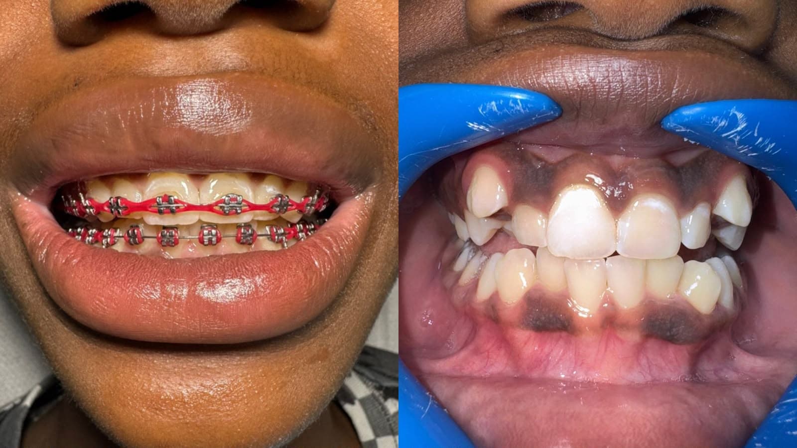 Tooth Separation — 3