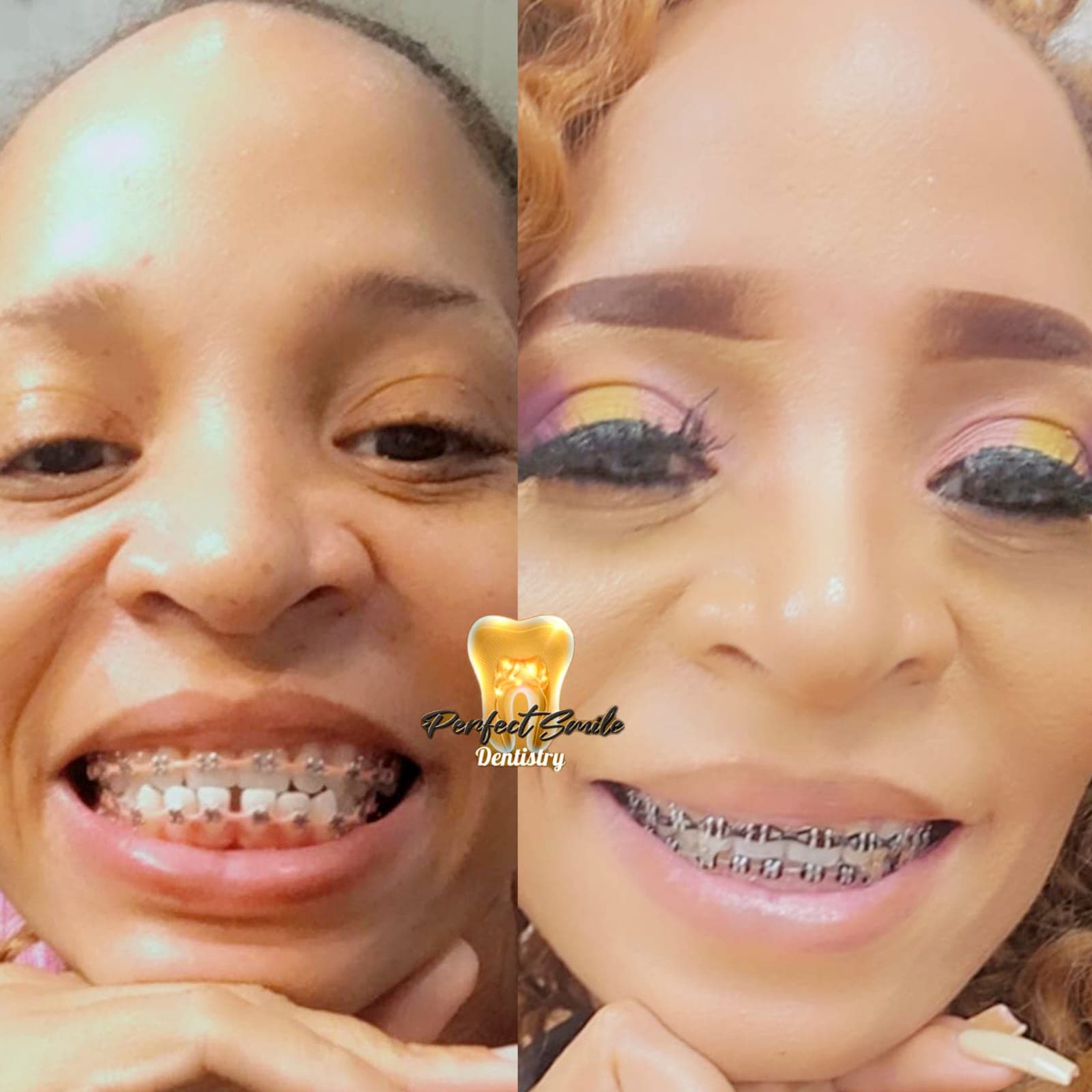 Gold Braces — 9