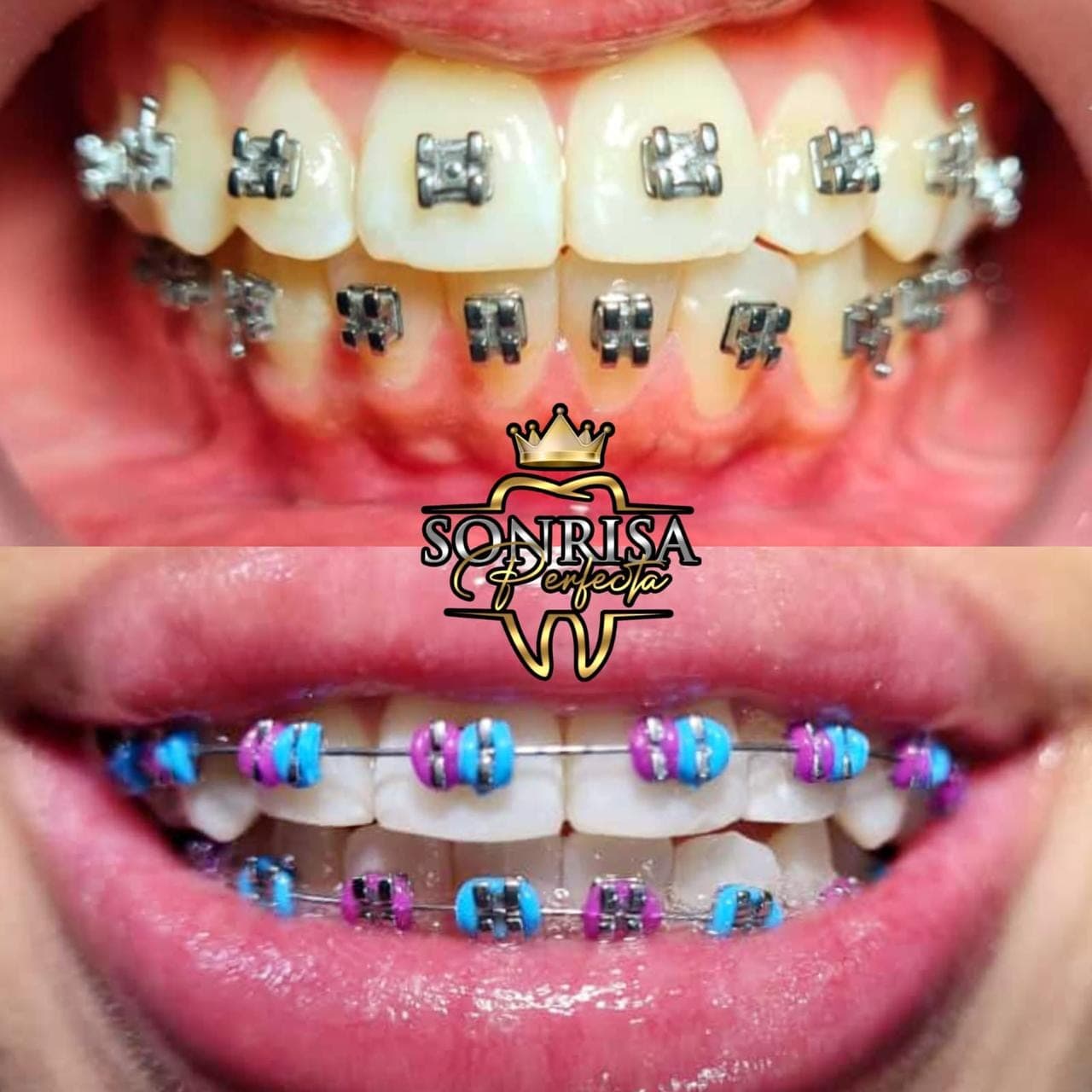 Braces Maintenance — 8