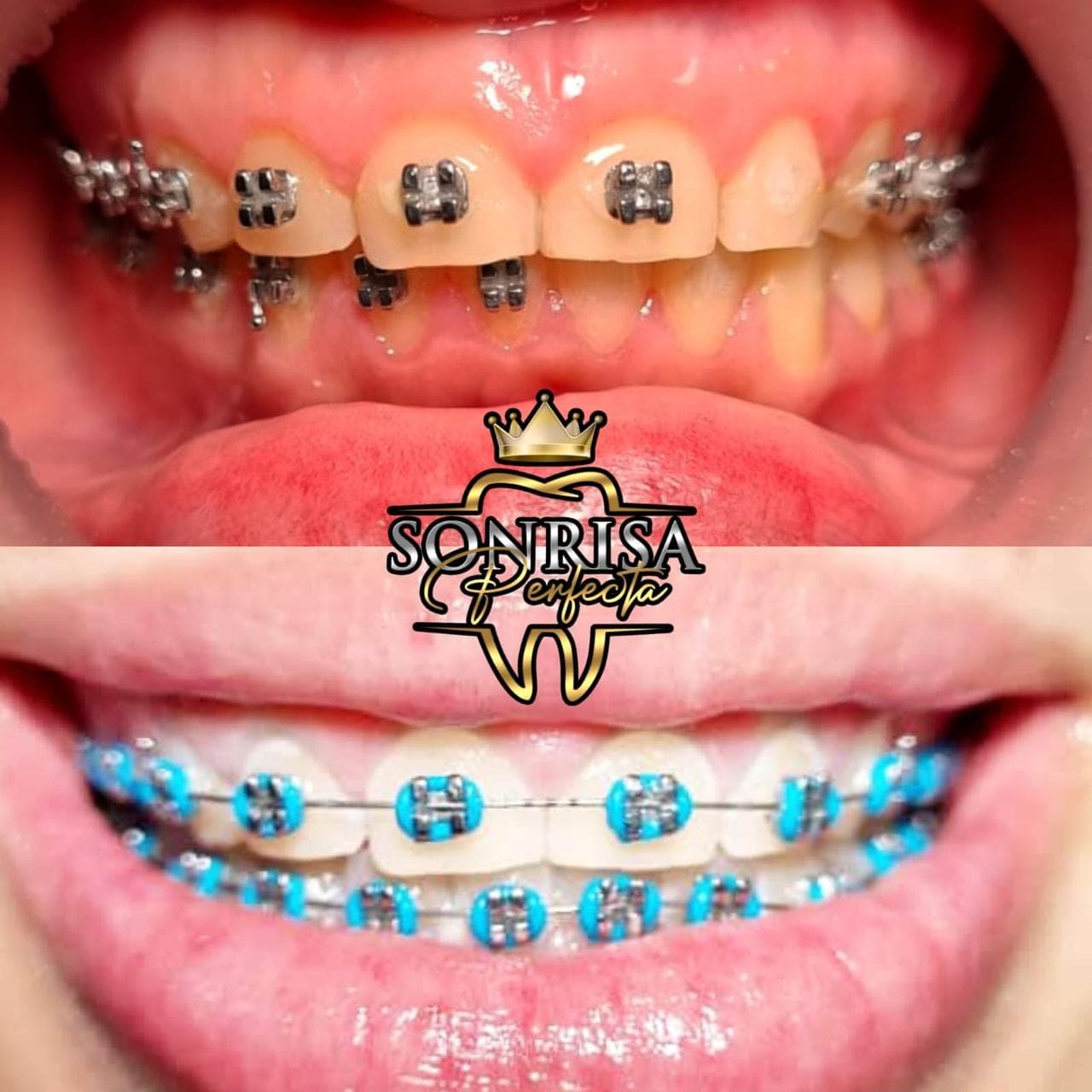 Metal Braces — 12