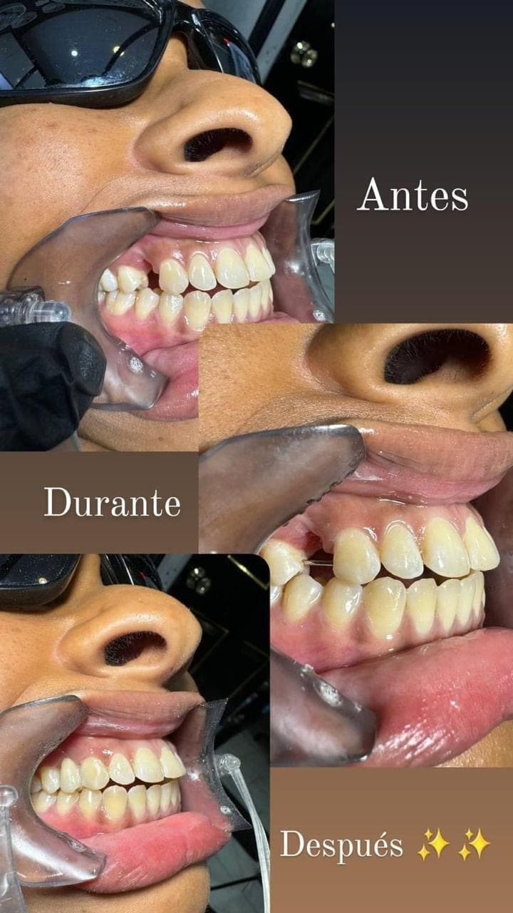 Teeth Whitening — 6