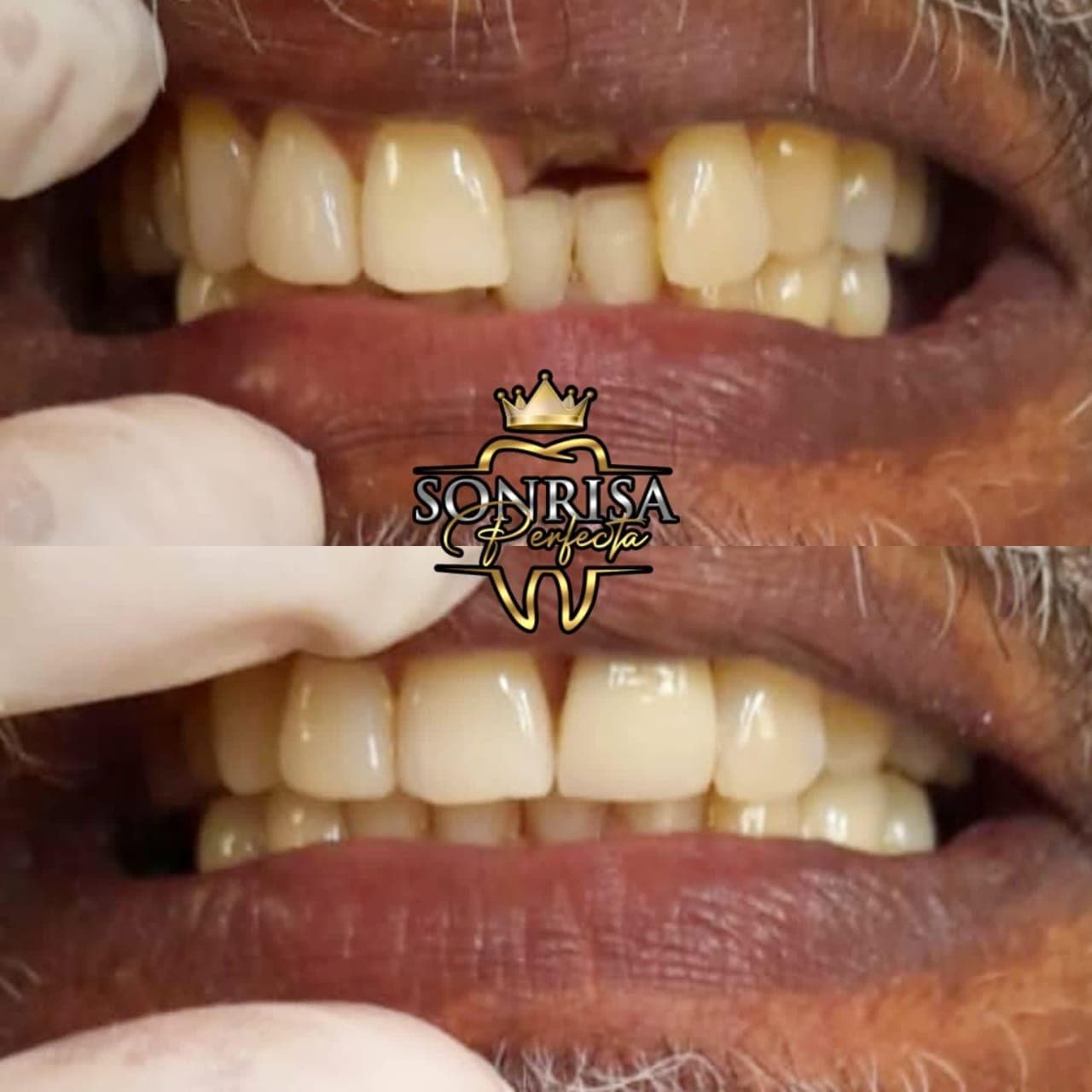 Permanent Dentures — 1