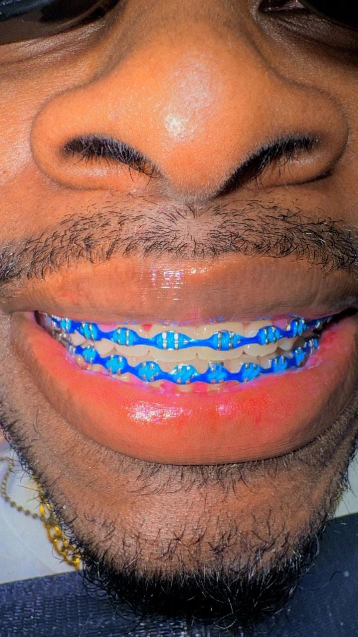 Metal Braces — 13