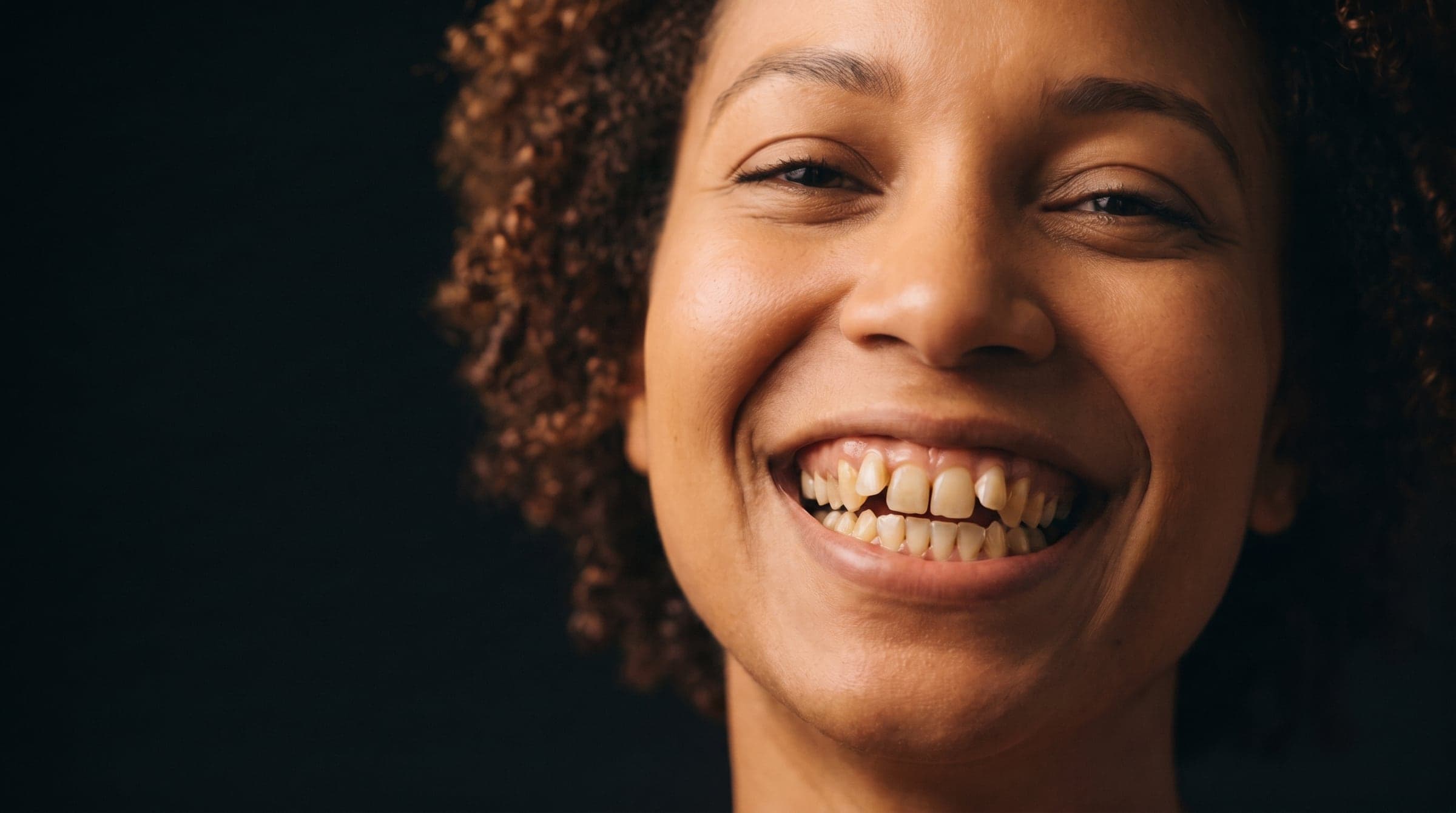 A smile before treatment, with crowded and uneven front teeth